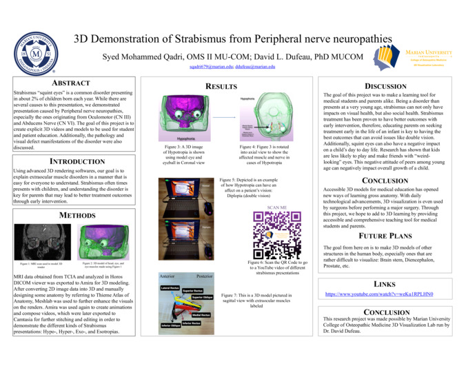 3D Demonstration of Strabismus from Peripheral nerve neuropathies miniatura