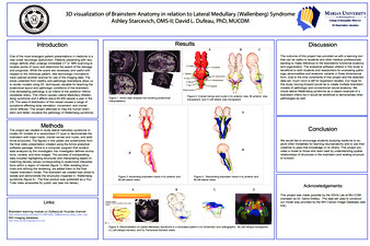 3D Visualization of Brainstem Anatomy in Relation to Lateral Medullary (Wallenberg) Syndrome Miniature