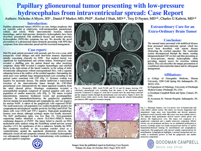 Papillary glioneuronal tumor presenting with low-pressure hydrocephalus from intraventricular spread: Case Report miniatura