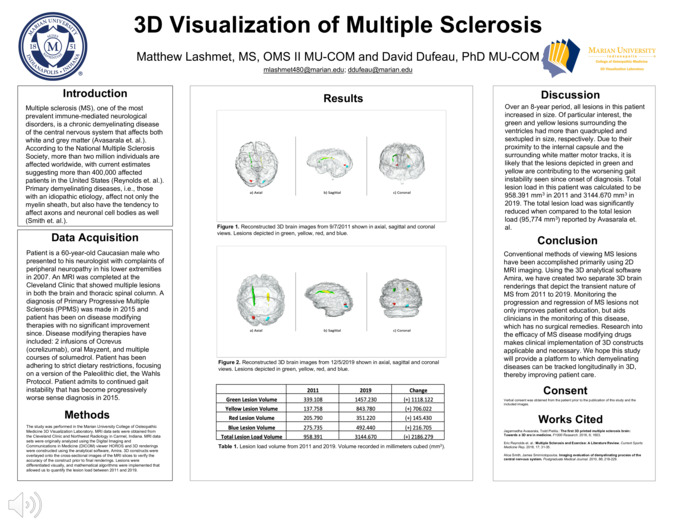 3D Visualization of Multiple Sclerosis Miniature