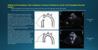 Sliding Arch Aortoplasty with Continuous Coronary Perfusion for Aortic Arch Hypoplasia Beyond Infancy miniatura